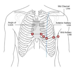 image of chest plaement for ECG leads