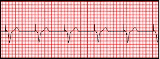 Image of chest placement for ECG leads 